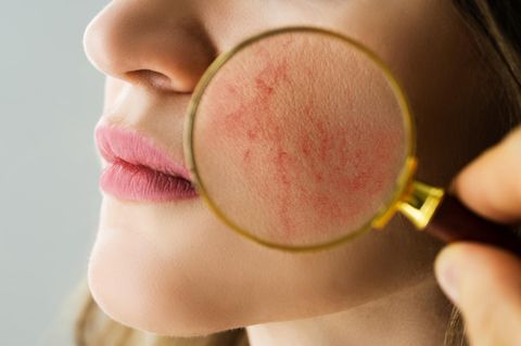 Untersuchung der Gesichtshaut mit Rosacea-Problemen