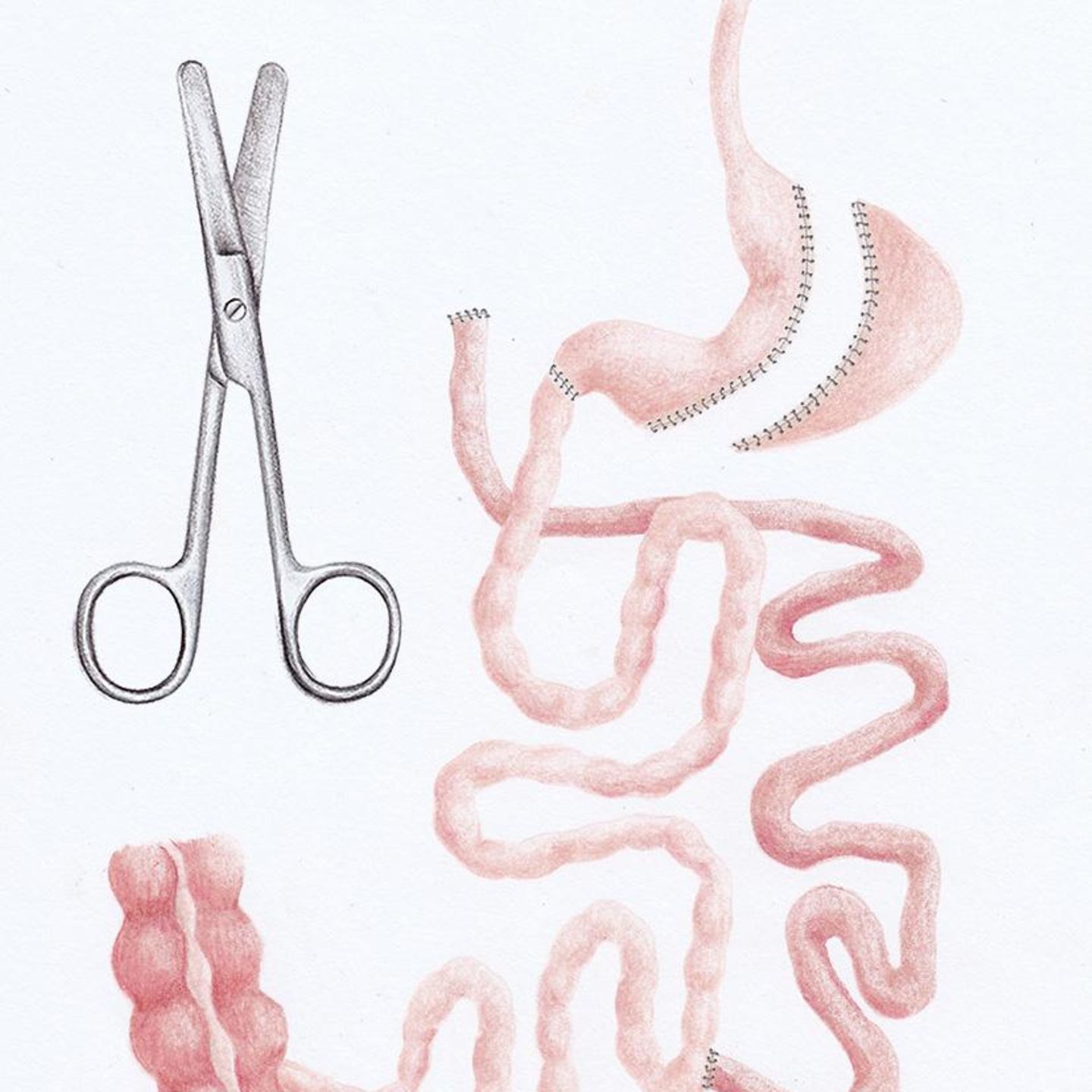 Eine OP-Schere neben einem Magen/Darm-Trakt