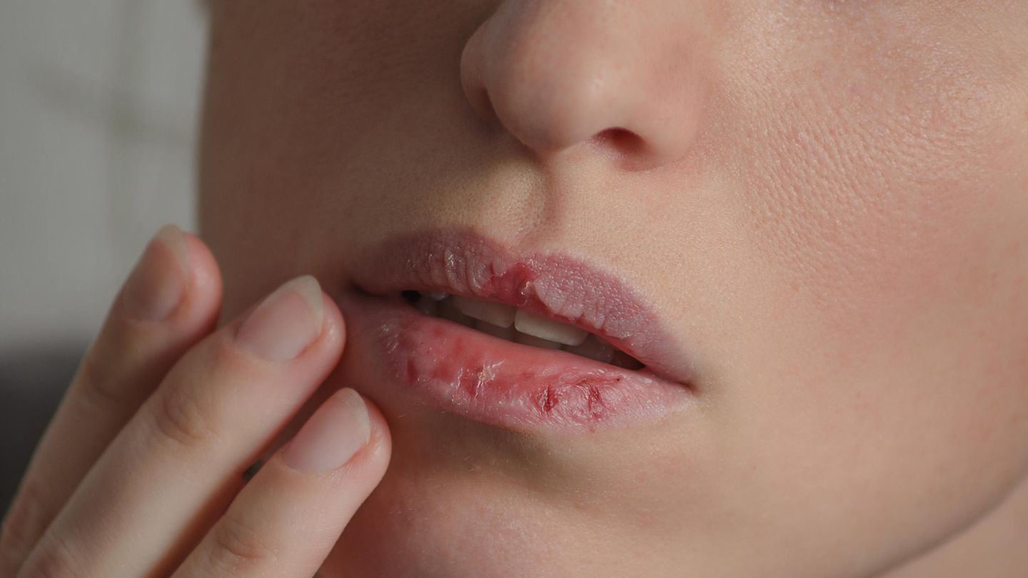 Fehlender Eigenschutz: Trockene Lippen? Diese Fehler sollten Sie vermeiden