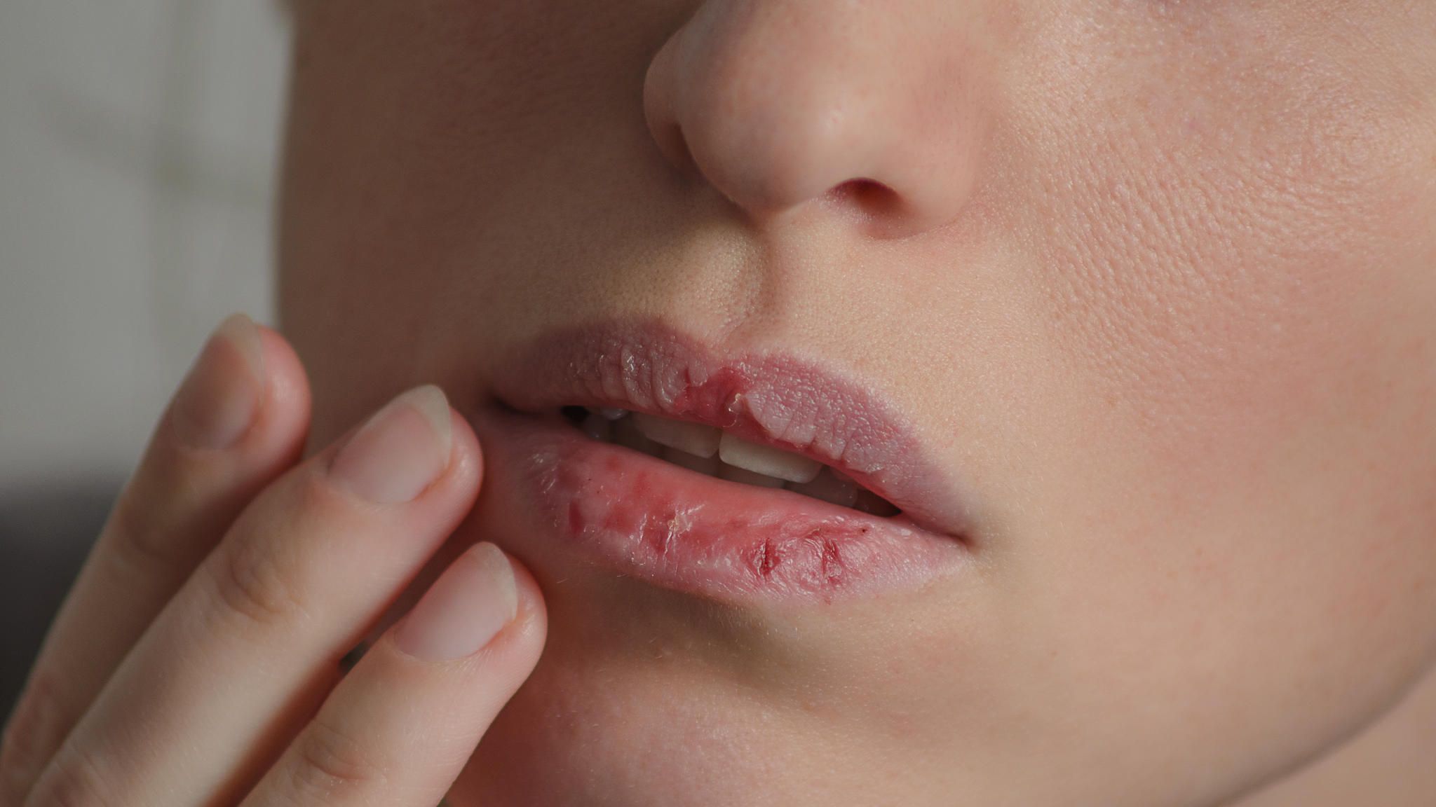 Trockene Lippen: Ursachen und Behandlungsmöglichkeiten