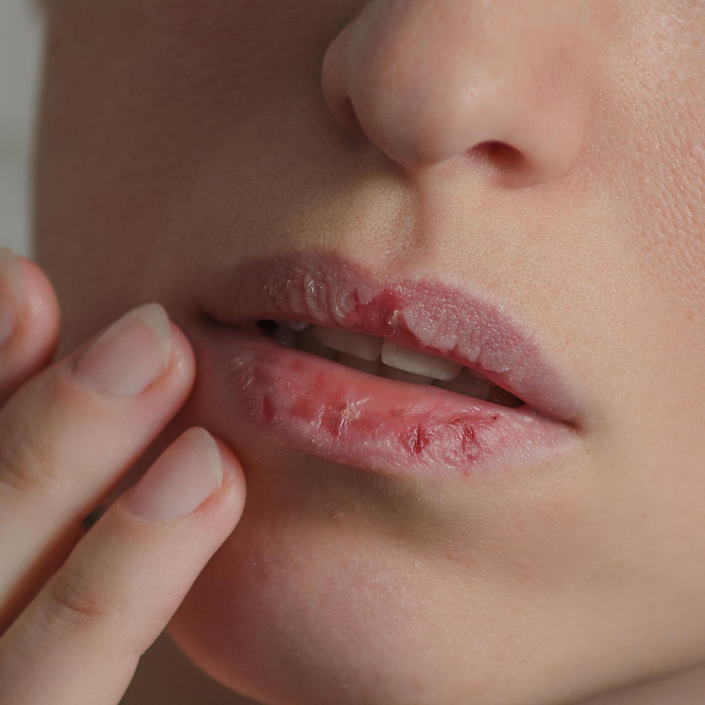 Trockene Lippen: Ursachen und Behandlungsmöglichkeiten