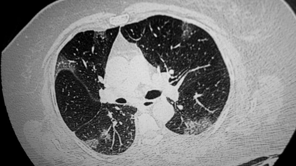 Coronavirus: CT-Aufnahme eines Patienten mit Covid-19
