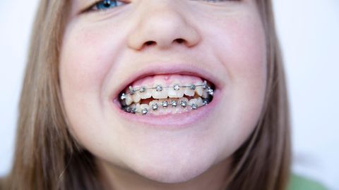 Schiefe Zähne: Zu oft, zu lange, zu schlecht: Was bei Zahnspangen schief läuft