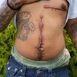 Chris' Operationswunde