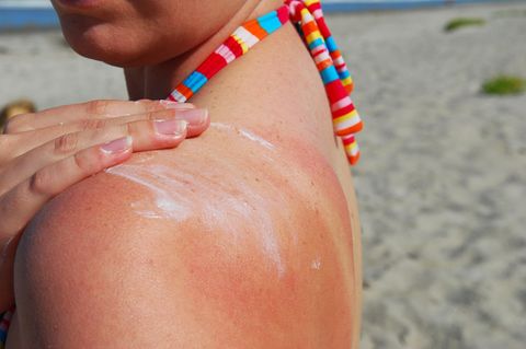 Gefährliche Strahlen: Endlich Sommer! So schützen Sie ihre Haut gegen Sonnenbrand und Co.