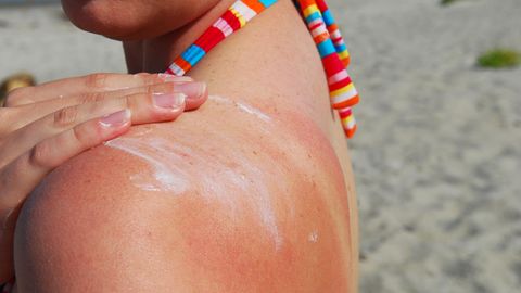 Gefährliche Strahlen: Endlich Sommer! So schützen Sie ihre Haut gegen Sonnenbrand und Co.