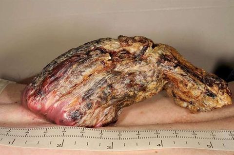 So groß wuchs das Karzinom heran.