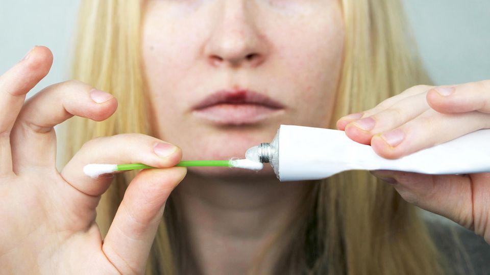 Eine Herpes-Creme hilft gegen Lippenbläschen