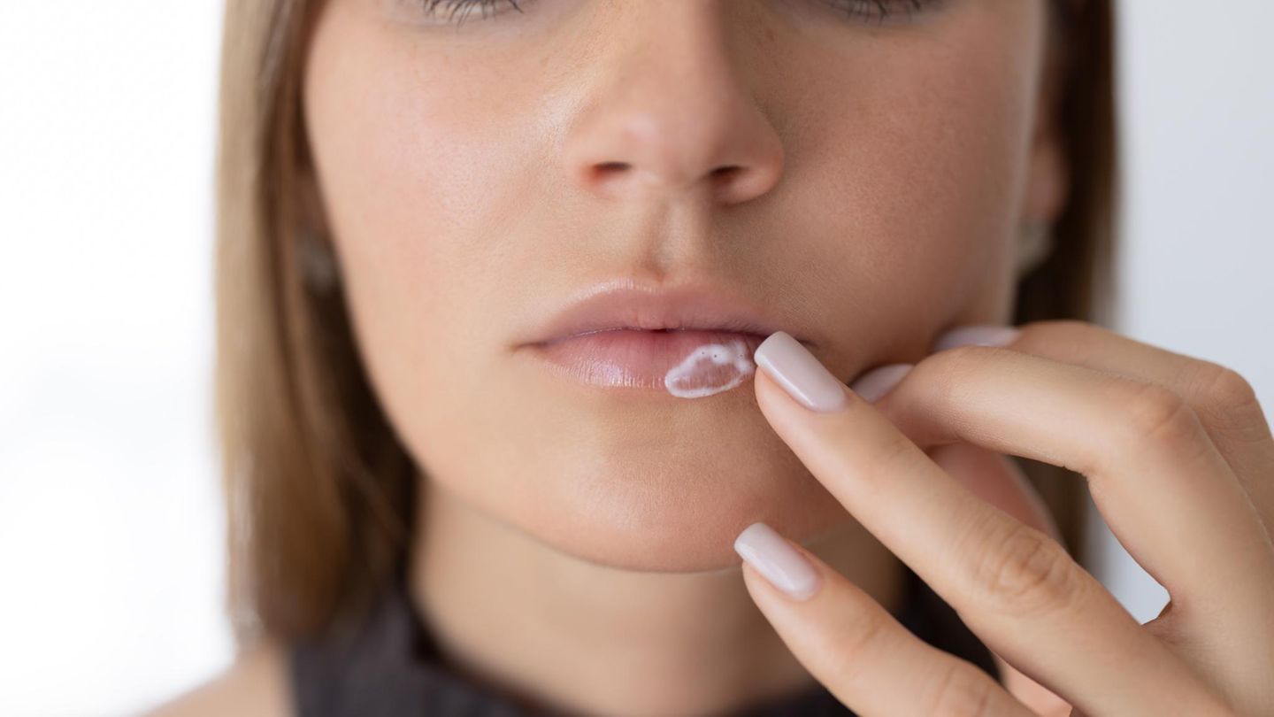 Lippenbläschen: Herpes-Creme im Vergleich: Diese Produkte li