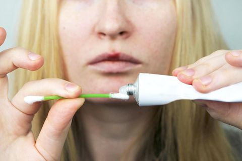 Eine Herpes-Creme hilft gegen Lippenbläschen
