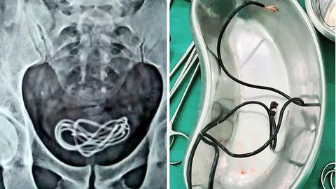 Indien: Ärzte finden 60 Zentimeter langes Ladekabel im Körper eines Patienten.