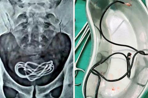 Indien: Ärzte finden 60 Zentimeter langes Ladekabel im Körper eines Patienten.