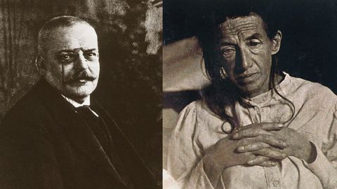 Wer ist Alzheimer?   Der Psychiater und Neuropathologe Alois Alzheimer beschrieb 1901 den Krankheitsverlauf seiner Patientin Auguste Deter. Mit nur 51 Jahren litt sie an "Vergesslichkeit und Wahnvorstellungen". Altersbedingte Demenz war damals bereits zwar bekannt, aber dafür war Deter viel zu jung. Sechs Jahre später starb sie "völlig verblödet", wie Alzheimer notierte. Bei der Obduktion erkannte der Arzt unter dem Mikroskop abgestorbene Nervenzellen sowie großflächige Ablagerungen im Gehirn. 1907 veröffentlichte Alzheimer eine Abhandlung über eine "eigenartige Erkrankung der Hirnrinde". Drei Jahre später bezeichnete das "Lehrbuch der Psychiatrie" diese Krankheit erstmals als Alzheimerische Krankheit – kurz: Alzheimer.