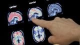 Alzheimer Demenz Früherkennung