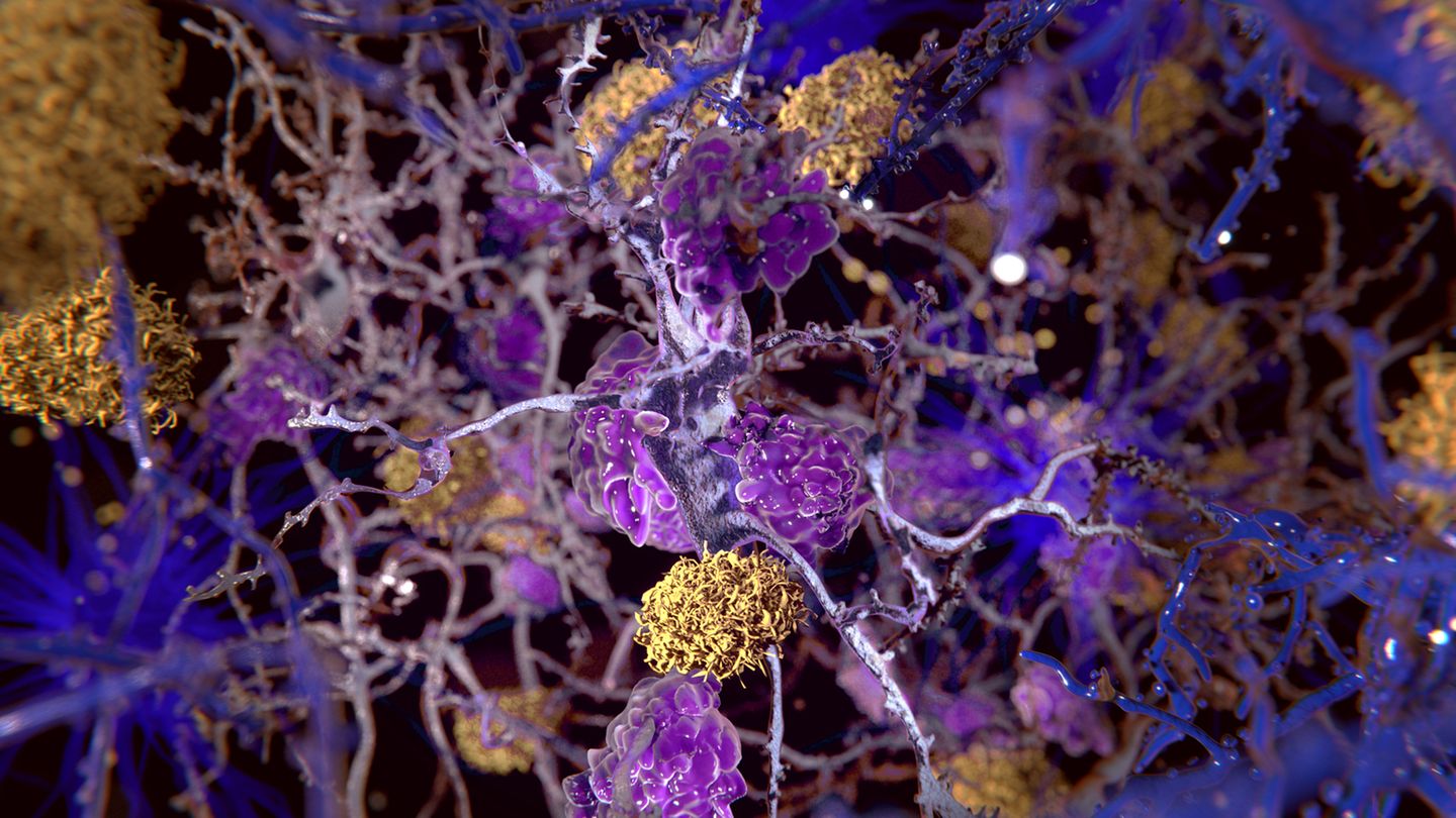 Alzheimer kann auch in den Genen liegen Alzheimer kann auch in den Genen liegen