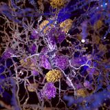 Alzheimer kann auch in den Genen liegen