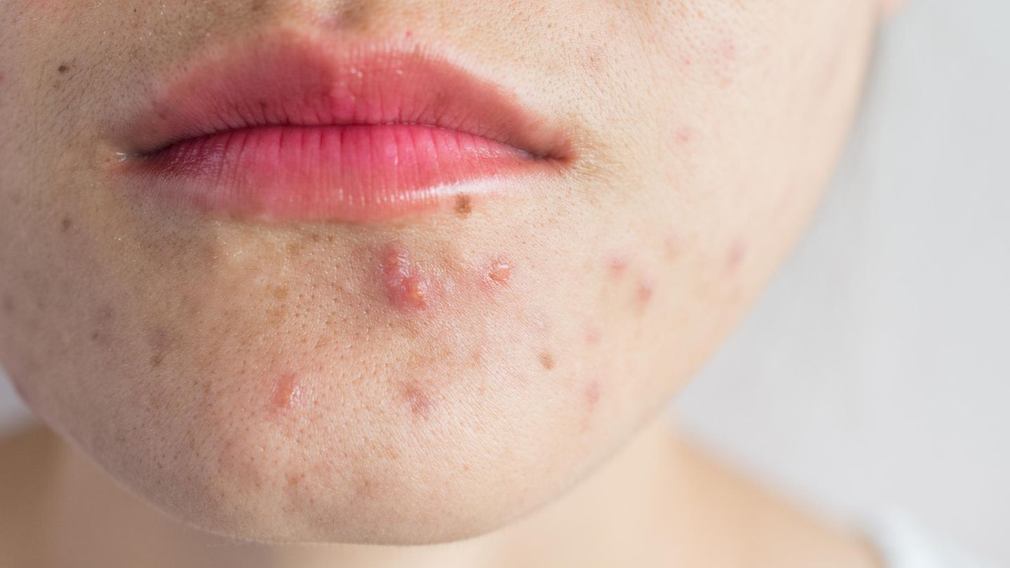 Unreine Haut kann jeden betreffen Unreine Haut kann jeden betreffen