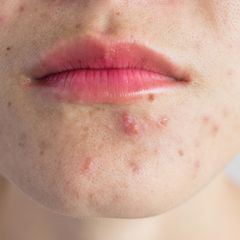 Unreine Haut kann jeden betreffen