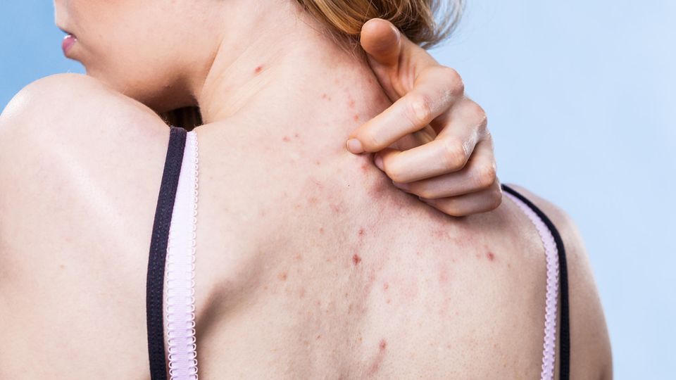 Unreine Haut tritt nicht nur im Gesicht auf, sondern auch an den Schultern, auf der Brust oder am Rücken Unreine Haut tritt nicht nur im Gesicht auf, sondern auch an den Schultern, auf der Brust oder am Rücken