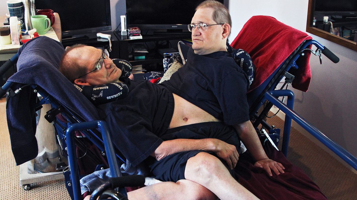 Die siamesischen Zwillinge Ronnie und Donnie Galyon in ihrem Spezialbett