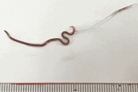 Diesen Wurm zogen Ärzte aus den Mandeln einer Patientin heraus 