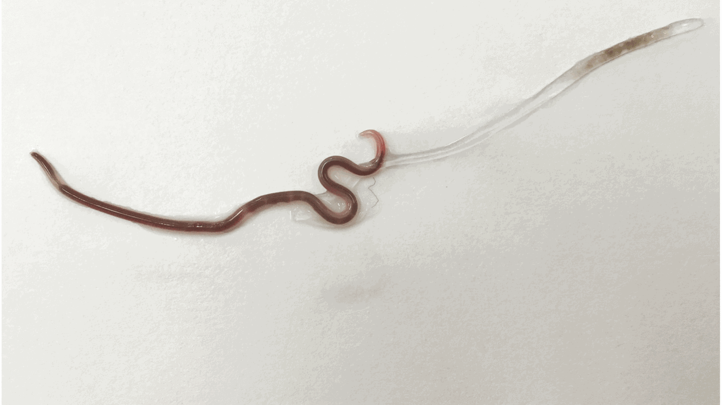 Diesen Wurm zogen Ärzte aus den Mandeln einer Patientin heraus 