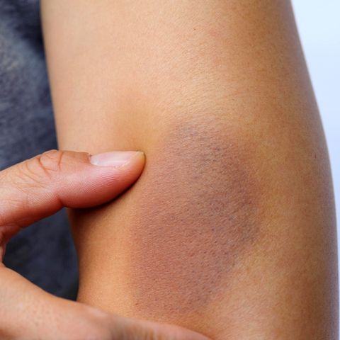 Die Diagnose: Sind ihre blauen Flecken Zeichen von Gewalt? Nein, die Frau hat eine Seemannskrankheit Die Diagnose: Sind ihre blauen Flecken Zeichen von Gewalt? Nein, die Frau hat eine Seemannskrankheit