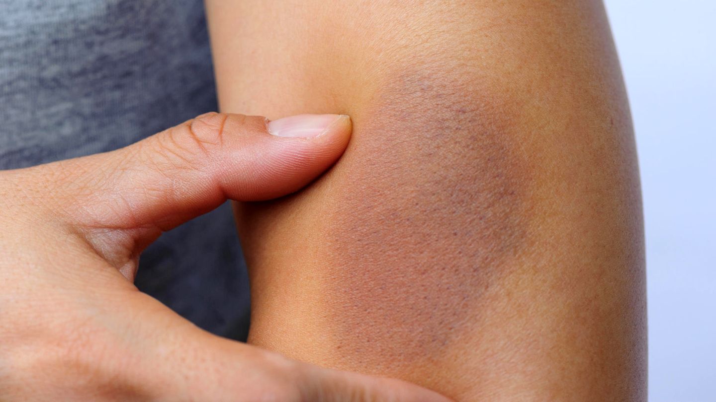 Die Diagnose: Sind ihre blauen Flecken Zeichen von Gewalt? Nein, die Frau hat eine Seemannskrankheit