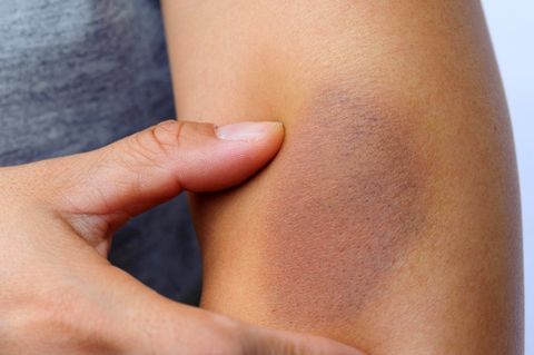 Die Diagnose: Sind ihre blauen Flecken Zeichen von Gewalt? Nein, die Frau hat eine Seemannskrankheit