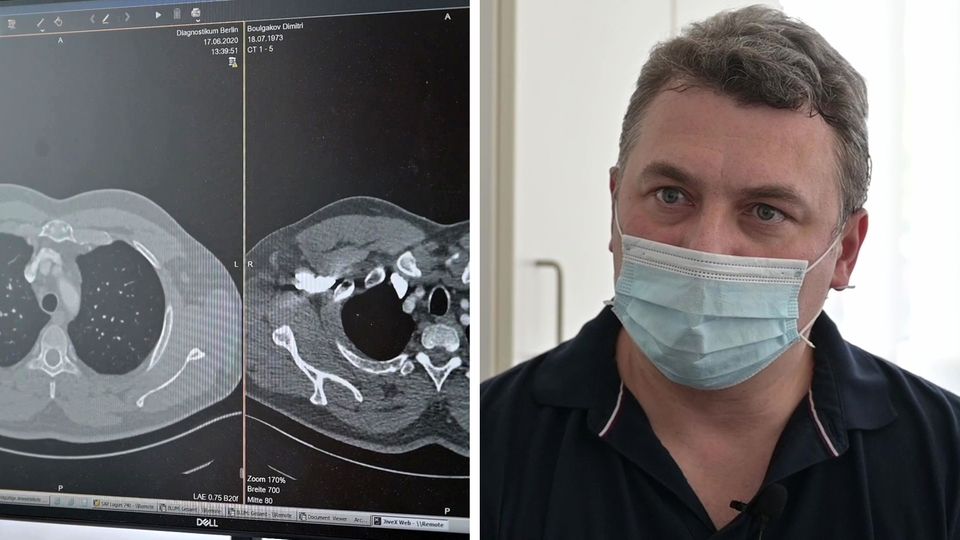 Milchglasmuster: Corona-Spätfolgen alarmieren Ärzte Milchglasmuster: Corona-Spätfolgen alarmieren Ärzte