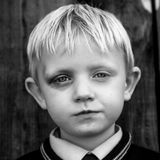 Ein Junge mit einem blauen Auge