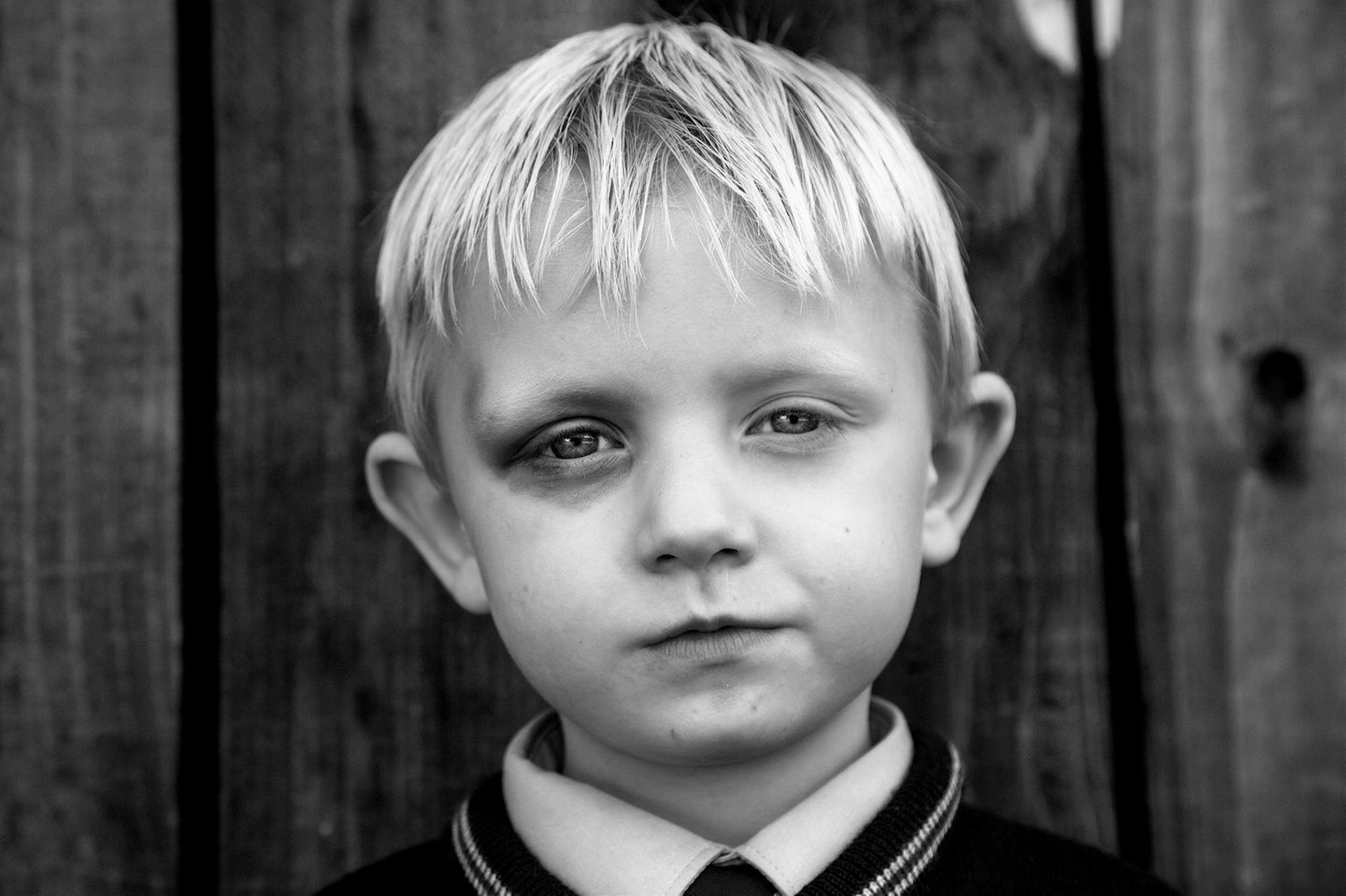 Ein Junge mit einem blauen Auge
