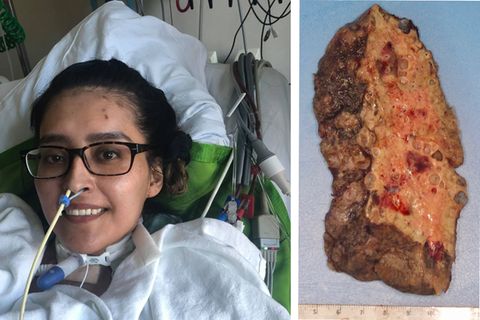 Kampf gegen Covid-19: "Virus überwältigte ihre Lunge" – 28-Jährige erhält doppelte Lungentransplantation