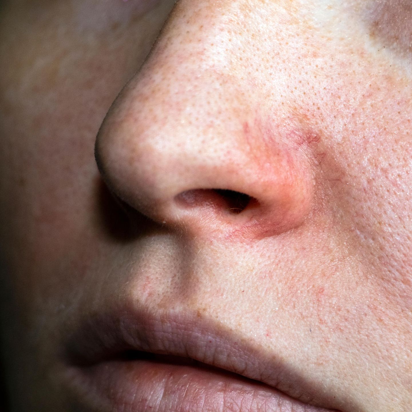 Rosacea heilerde bei Rosacea