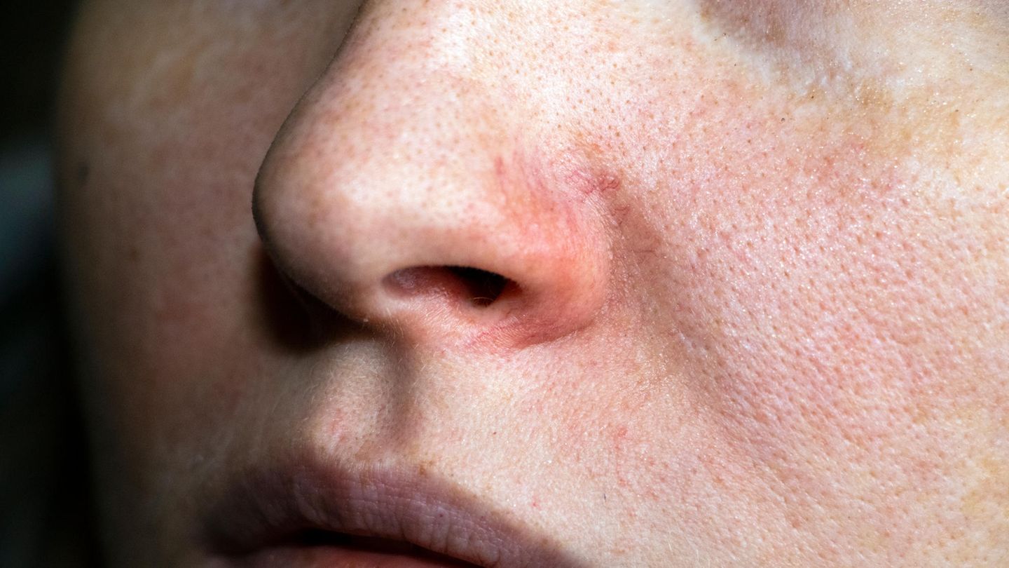 Rosacea Creme Rote Aderchen Im Gesicht Lindern Stern De