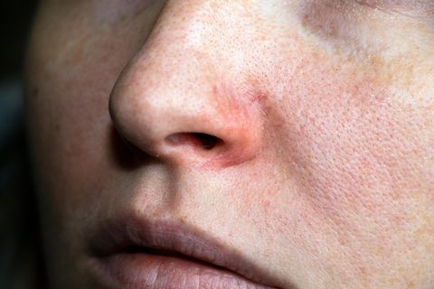 Rosacea Creme gegen Rötungen
