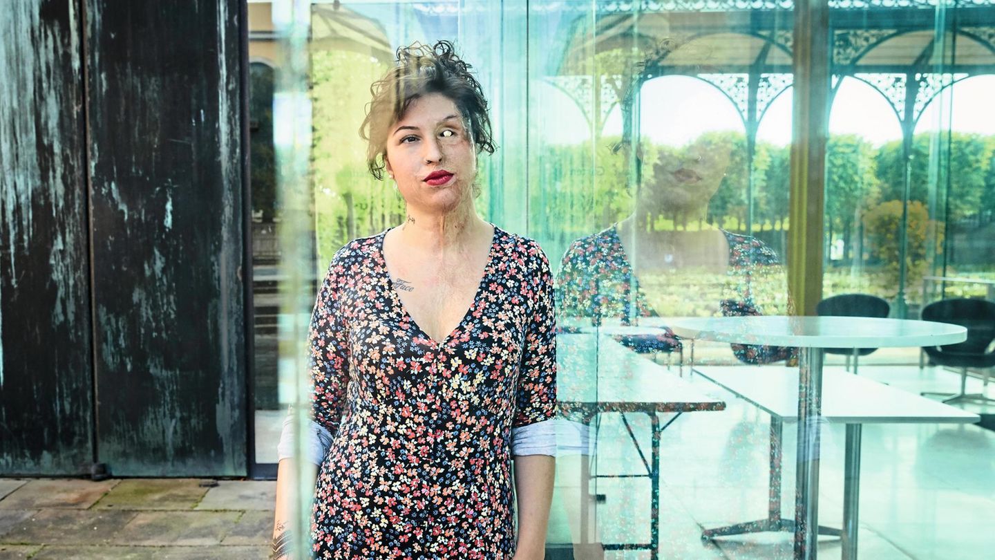 Thema: "Bis das der Tod Euch scheidet". Menschen berichten stern-Reporterin Anette Lache über den Versuch ihres Ehepartners sie zu töten. Hier im Foto: Vanessa Münstermann wurde von ihrem Mann mit Säure überschüttet. Vanessa Münstermann