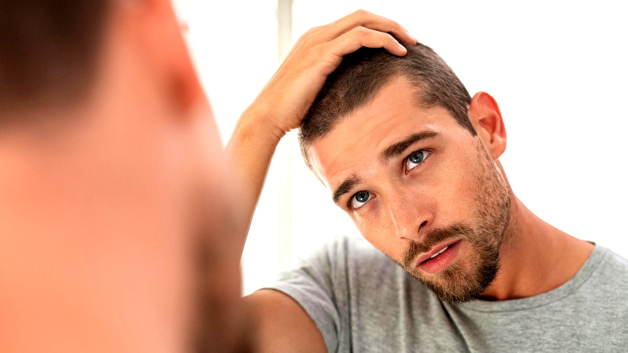 Haarausfall beim Mann