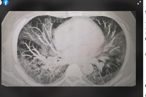 CT-Bild einer geschädigten Lunge