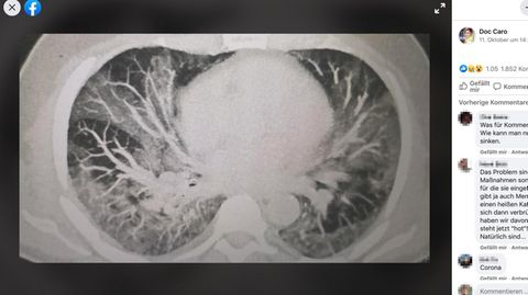 CT-Bild einer geschädigten Lunge