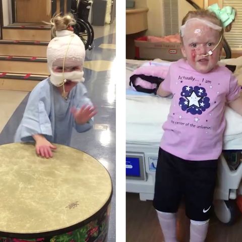 Herzzerreißendes Video: Vierjährige erleidet schwere Verbrennungen – und muntert trotzdem ihre Familie auf