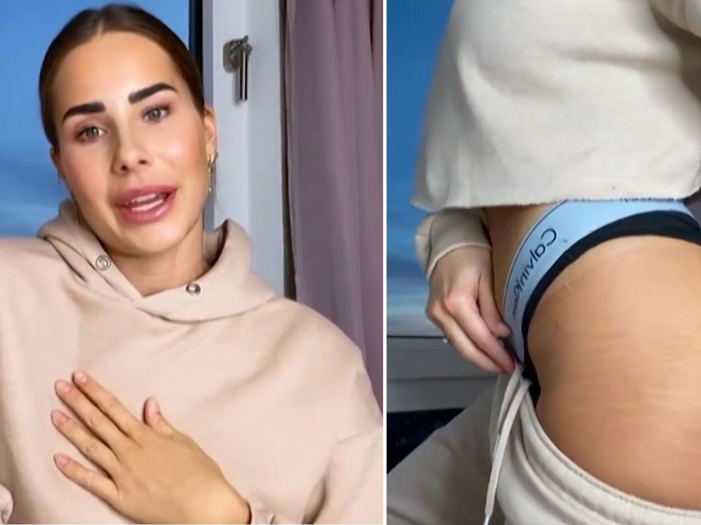 Video: Dehnungsstreifen und Cellulite – Model platzt der Kragen