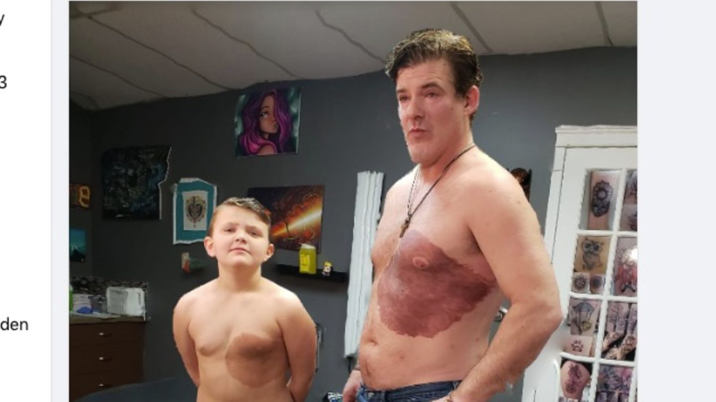 Vater und Sohn stehen nebeneinander. Der Sohn mit Muttermal, der Vater mit einem identischen Tattoo
